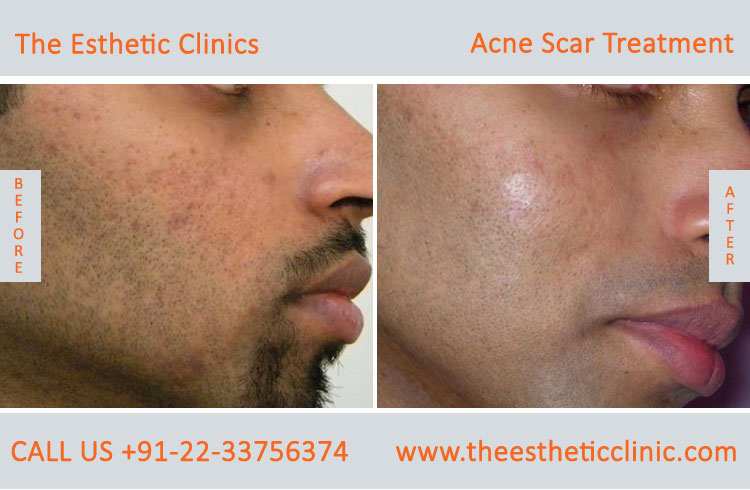 face acne scars removal laser treatment before after photos in mumbai india (3)